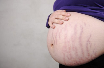 孕期准妈们 挑战妊娠纹三部曲