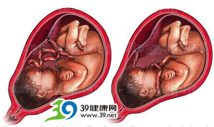 脐带六大变异严重危害胎儿生命