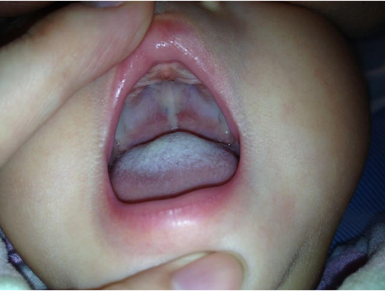 奶嘴消毒不当宝宝易患鹅口疮 选对消毒方法是关键
